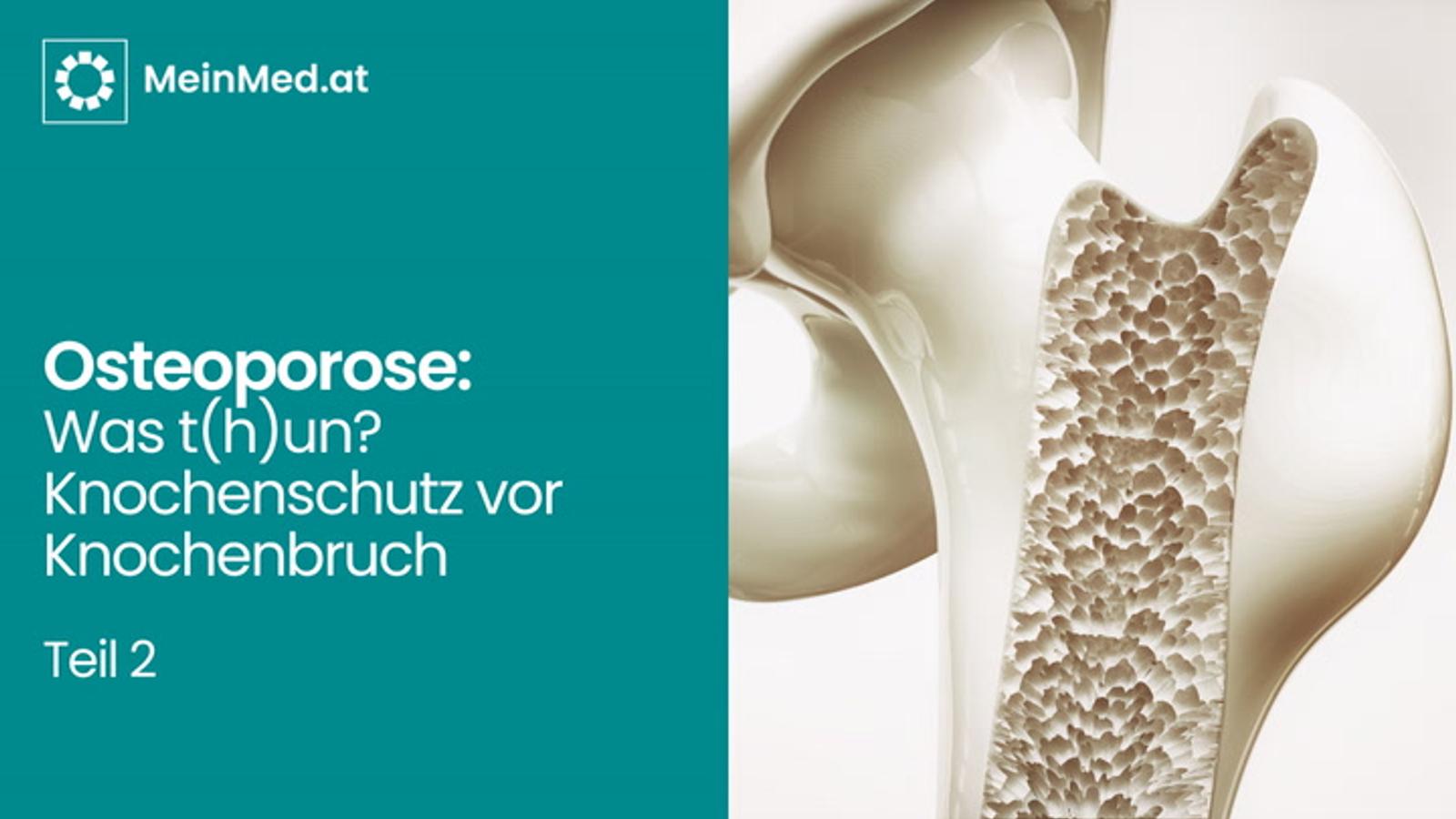 Osteoporose: Was T(h)un? KnochenSCHUTZ vor KnochenBRUCH! – Teil 2